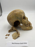 A Real Uncut Human Skull Damaged Temporal #265