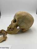 A Real Uncut Human Skull Damaged Temporal #265