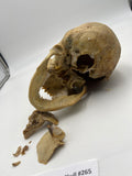 A Real Uncut Human Skull Damaged Temporal #265