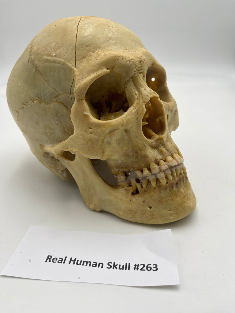 A Real Uncut Human Skull With Cracked Calvarium #263