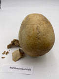 A Real Uncut Human Skull Damaged Temporal #265