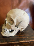 Antique Human Skull With Possible Pathology / Trauma and Antique Case