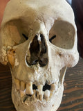 Antique Human Skull With Possible Pathology / Trauma and Antique Case