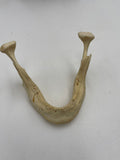 Antique Edentulous Jaw Pathology Display with Real Human Mandibles