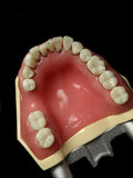 Kilgore Dental Model Of Various Tooth Erosion