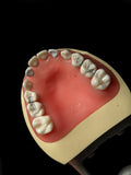 Pediatric Dental Model With Fillings And Caps