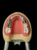 Pediatric Dental Model With Fillings And Caps