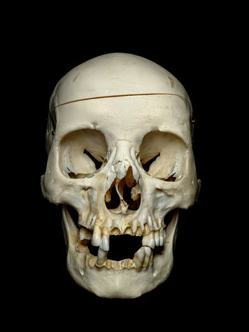 Maxillofacial Fracture Female Human Skull