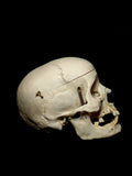 Maxillofacial Fracture Female Human Skull
