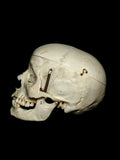 Maxillofacial Fracture Female Human Skull