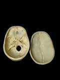 Maxillofacial Fracture Female Human Skull