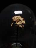 Pathology Anencephaly Fetal Human Skull